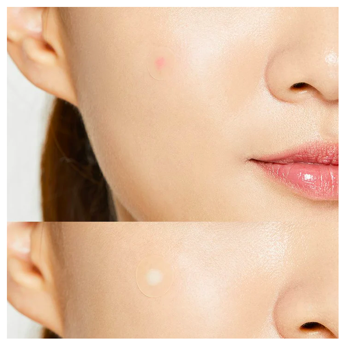 Acne Pimple Master Patch - 24 Parches anti acné cosrx
